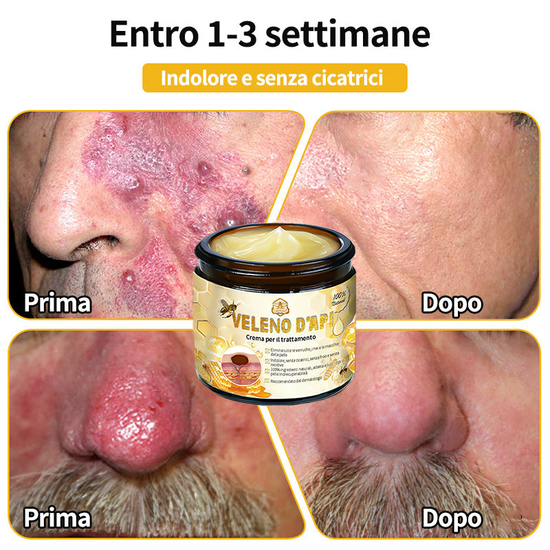 BigeBee™ 🌿Crema per il trattamento della pelle al veleno d'api