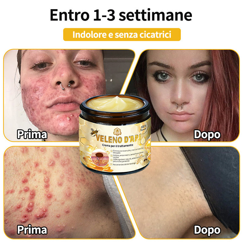 BigeBee™ 🌿Crema per il trattamento della pelle al veleno d'api
