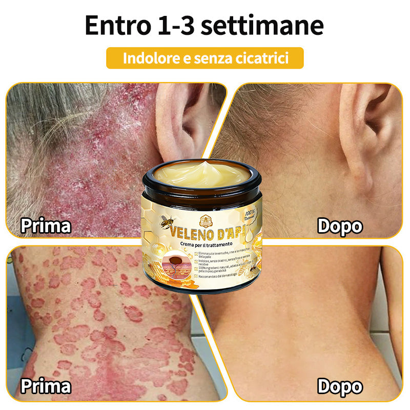 BigeBee™ 🌿Crema per il trattamento della pelle al veleno d'api